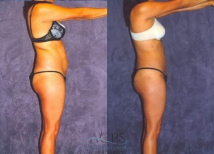 Before & After Liposuction Case 376 Side View: View in Houston, TX