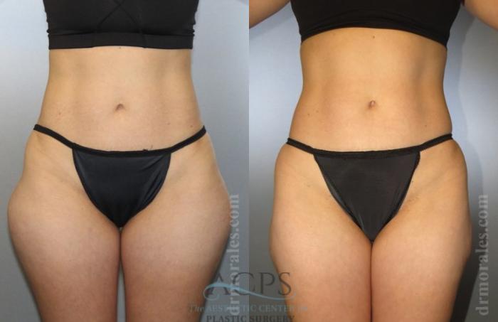Before & After Liposuction Case 377 Front View: View in Houston, TX