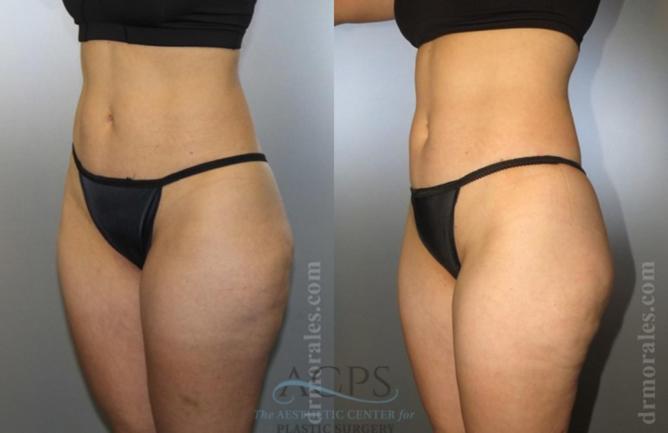 Before & After Liposuction Case 377 Oblique View: View in Houston, TX