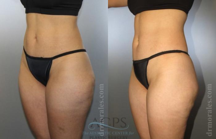 Before & After Liposuction Case 377 Oblique View: View in Houston, TX
