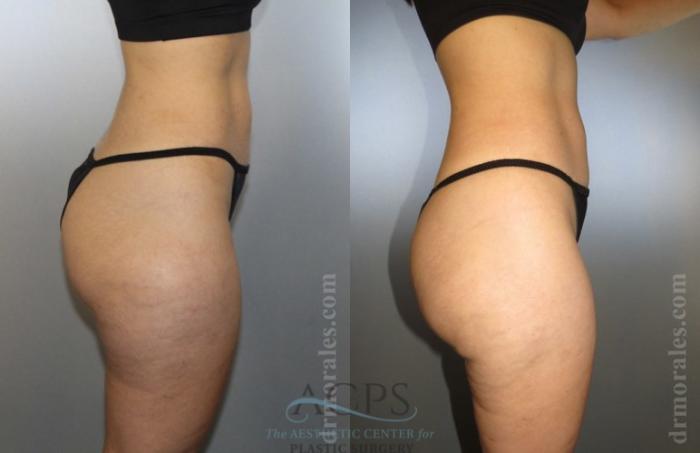 Before & After Liposuction Case 377 Side View: View in Houston, TX