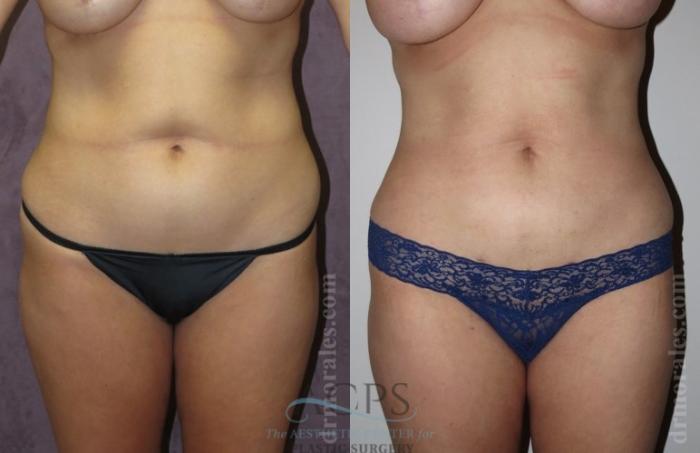 Before & After Liposuction Case 378 Front View: View in Houston, TX
