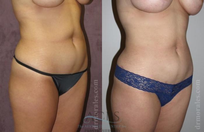 Before & After Liposuction Case 378 Side View: View in Houston, TX