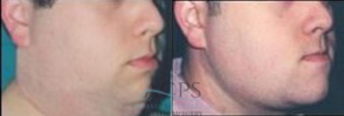 Before & After Liposuction Case 379 Oblique View: View in Houston, TX