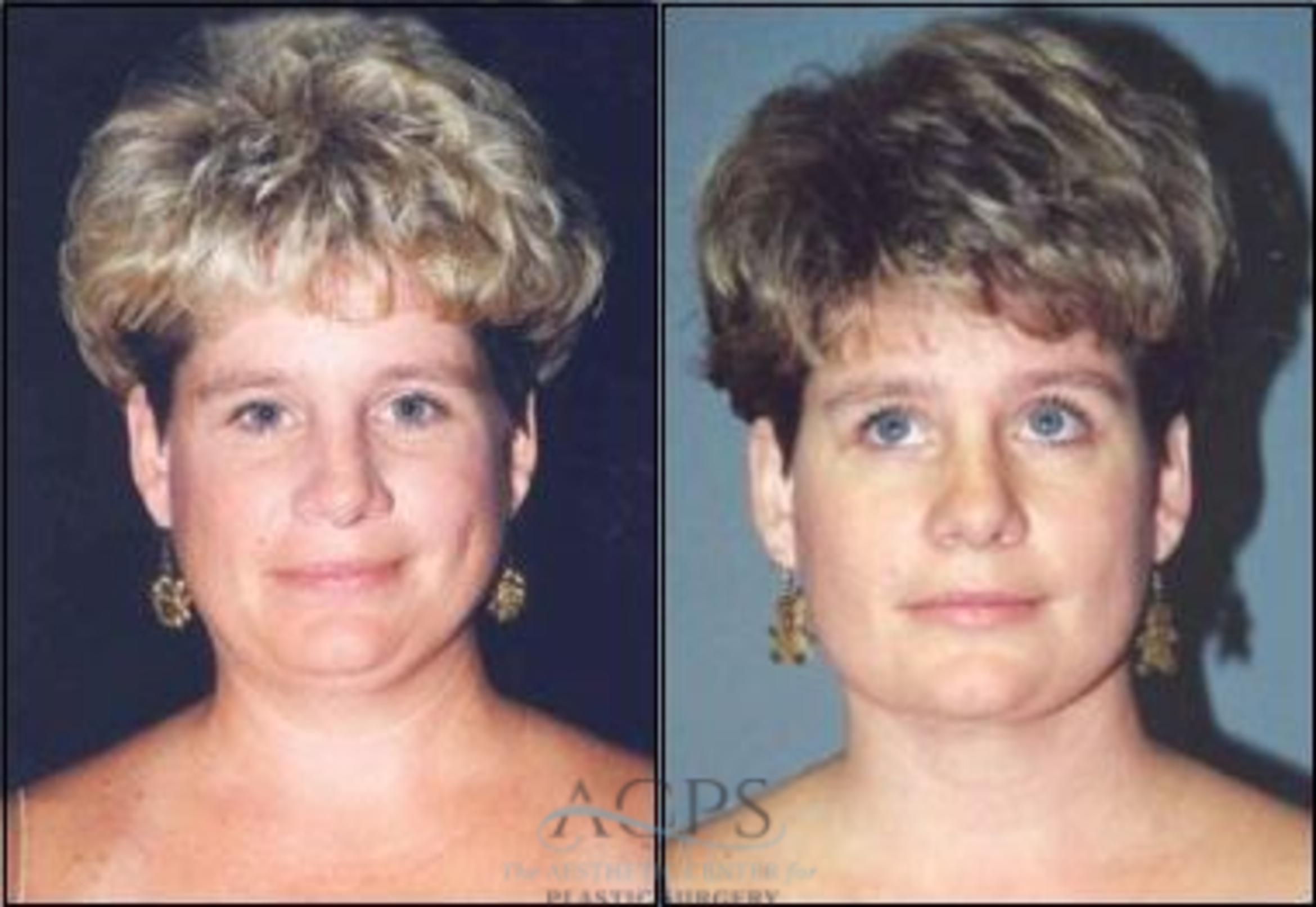 Before & After Liposuction Case 380 Front View: View in Houston, TX