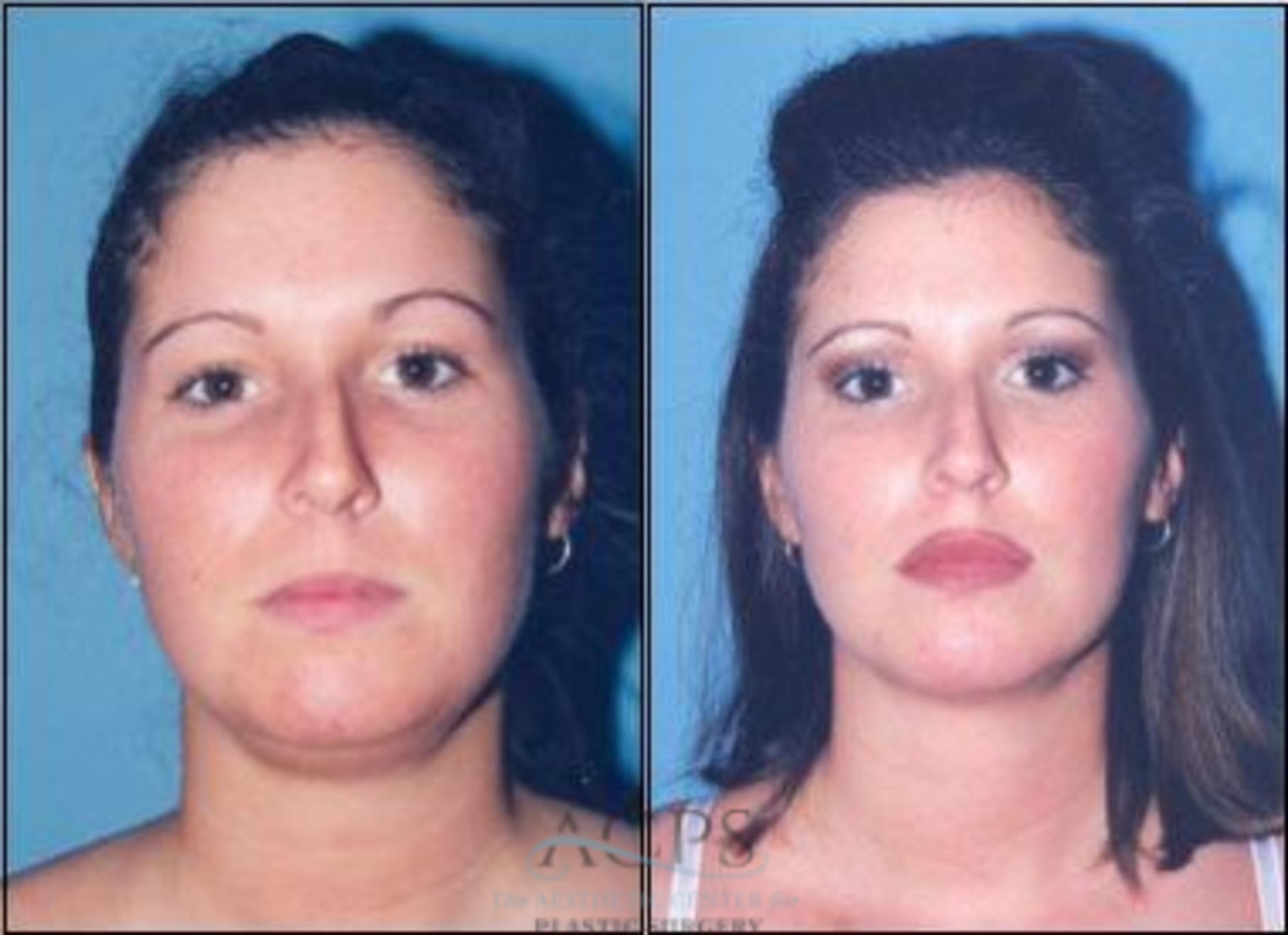 Before & After Liposuction Case 381 Front View: View in Houston, TX
