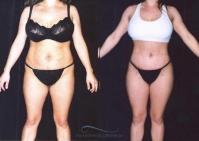 Before & After Liposuction Case 382 Front View: View in Houston, TX