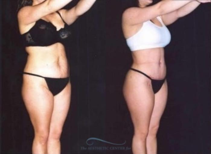 Before & After Liposuction Case 382 Oblique View: View in Houston, TX
