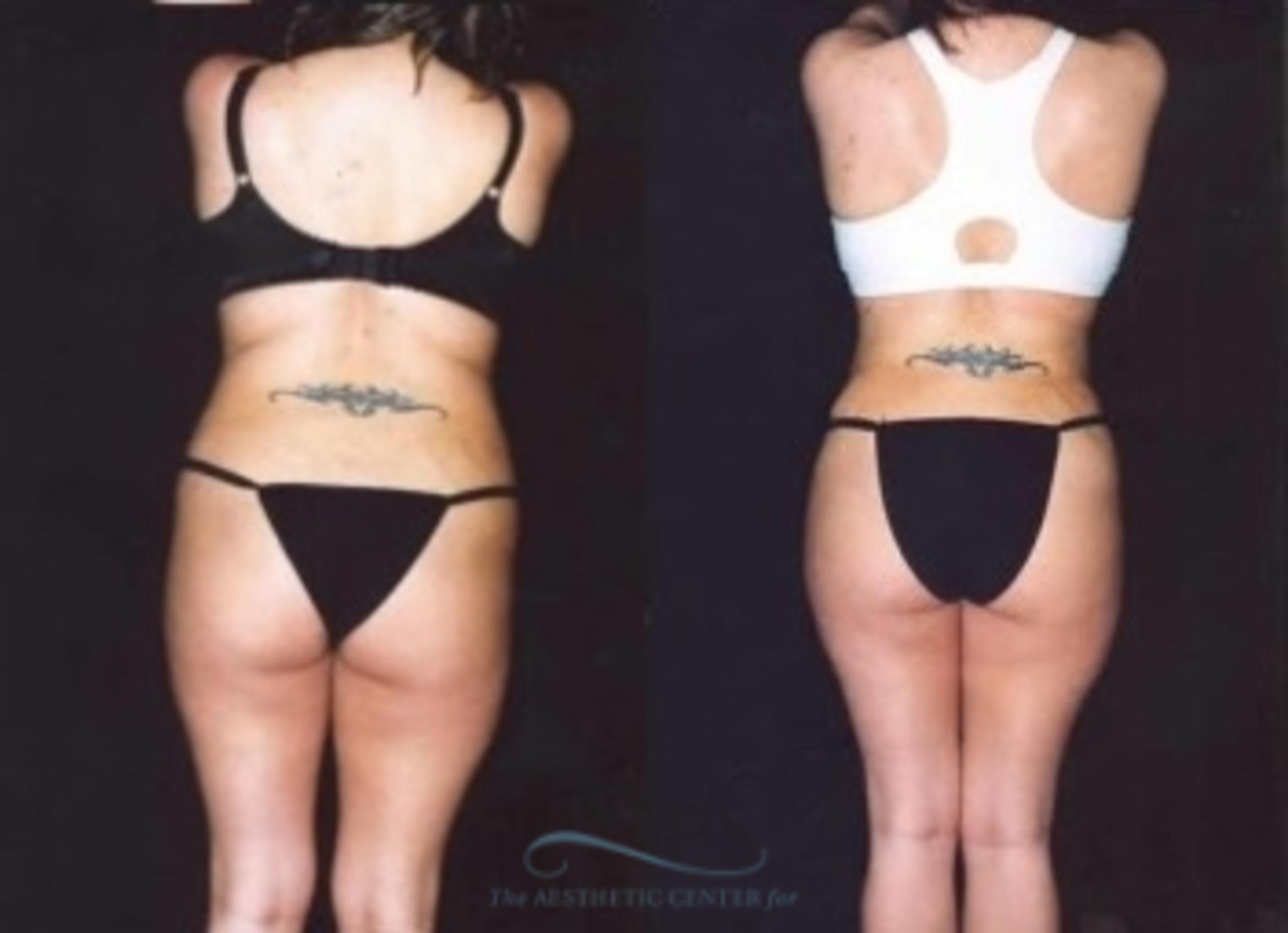 Before & After Liposuction Case 382 Rear View: View in Houston, TX
