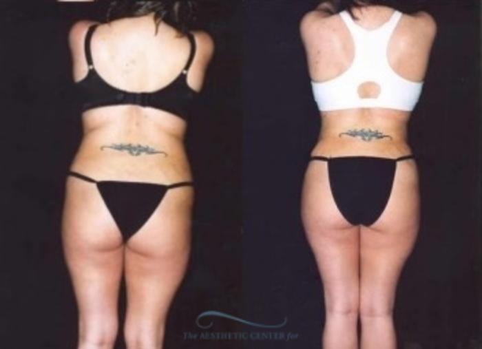 Before & After Liposuction Case 382 Rear View: View in Houston, TX