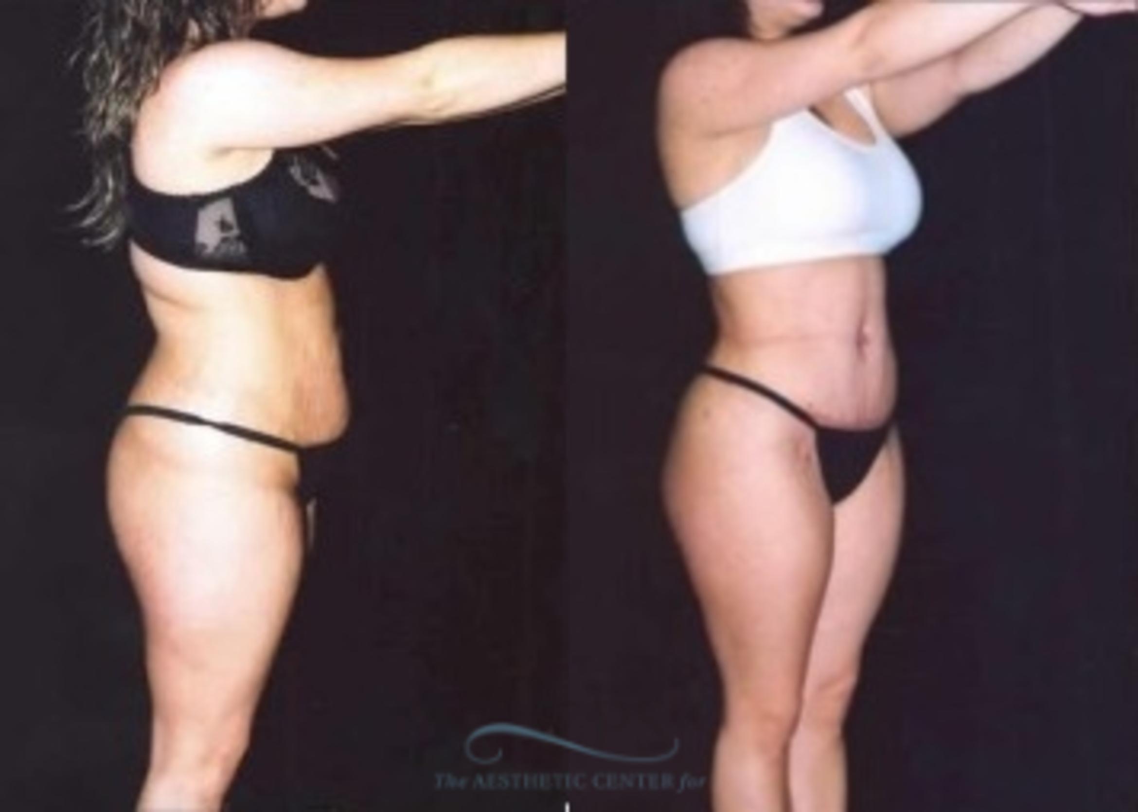 Before & After Liposuction Case 382 Side View: View in Houston, TX