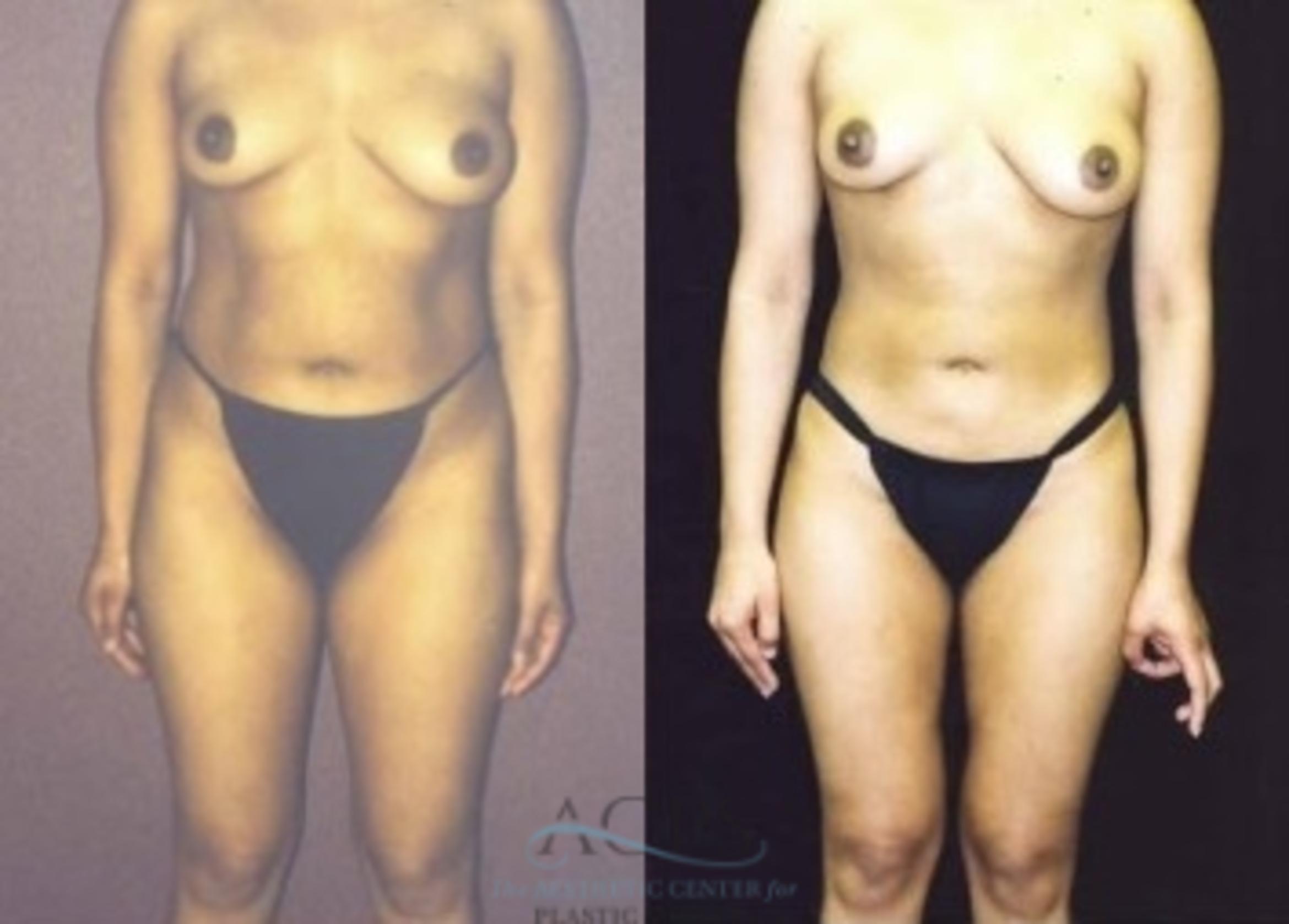 Before & After Liposuction Case 383 Front View: View in Houston, TX