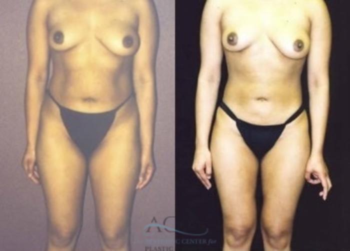 Before & After Liposuction Case 383 Front View: View in Houston, TX