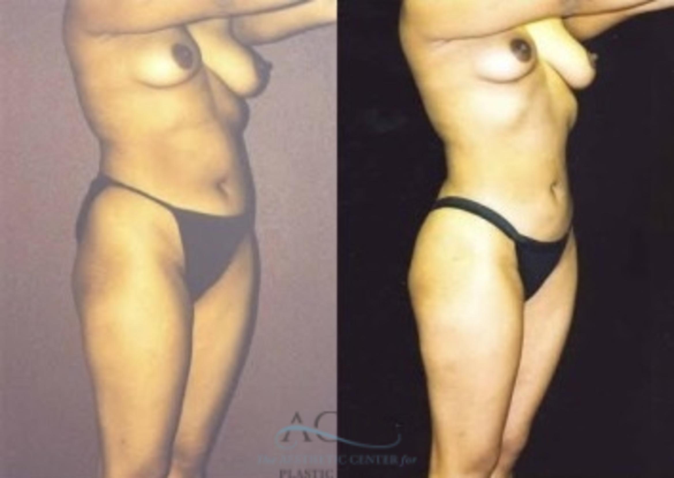 Before & After Liposuction Case 383 Oblique View: View in Houston, TX