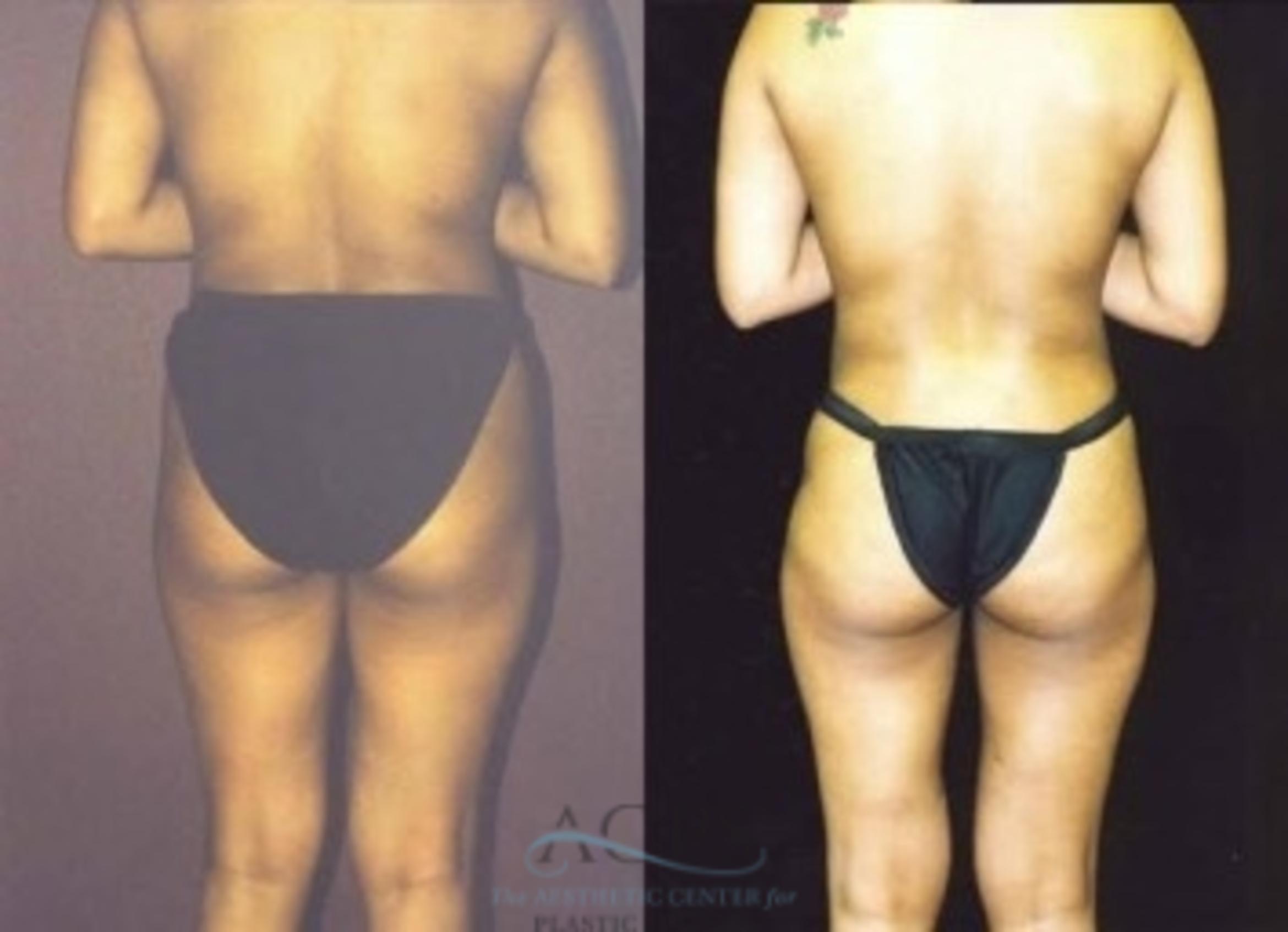 Before & After Liposuction Case 383 Rear View: View in Houston, TX