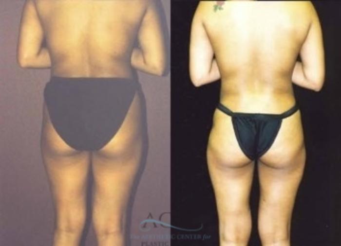 Before & After Liposuction Case 383 Rear View: View in Houston, TX