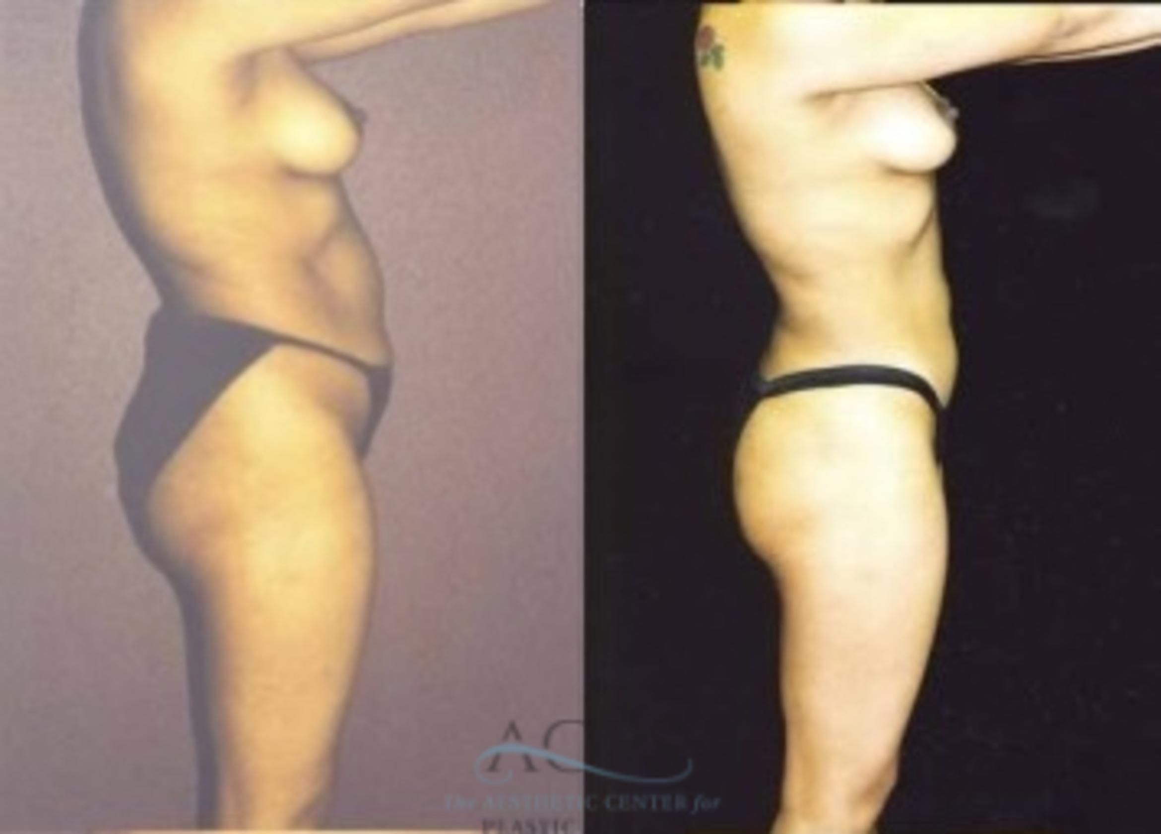 Before & After Liposuction Case 383 Side View: View in Houston, TX