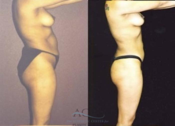 Before & After Liposuction Case 383 Side View: View in Houston, TX