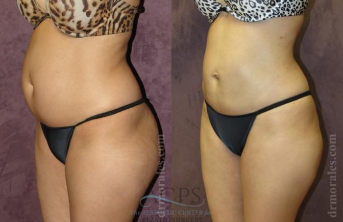 Before & After Liposuction Case 384 Oblique View: View in Houston, TX