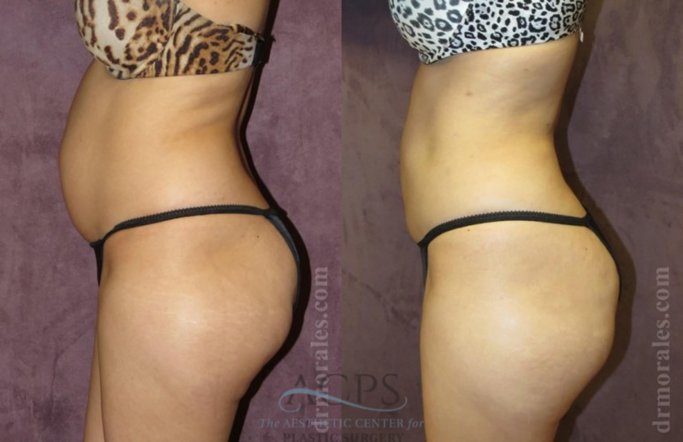 Before & After Liposuction Case 384 Side View: View in Houston, TX