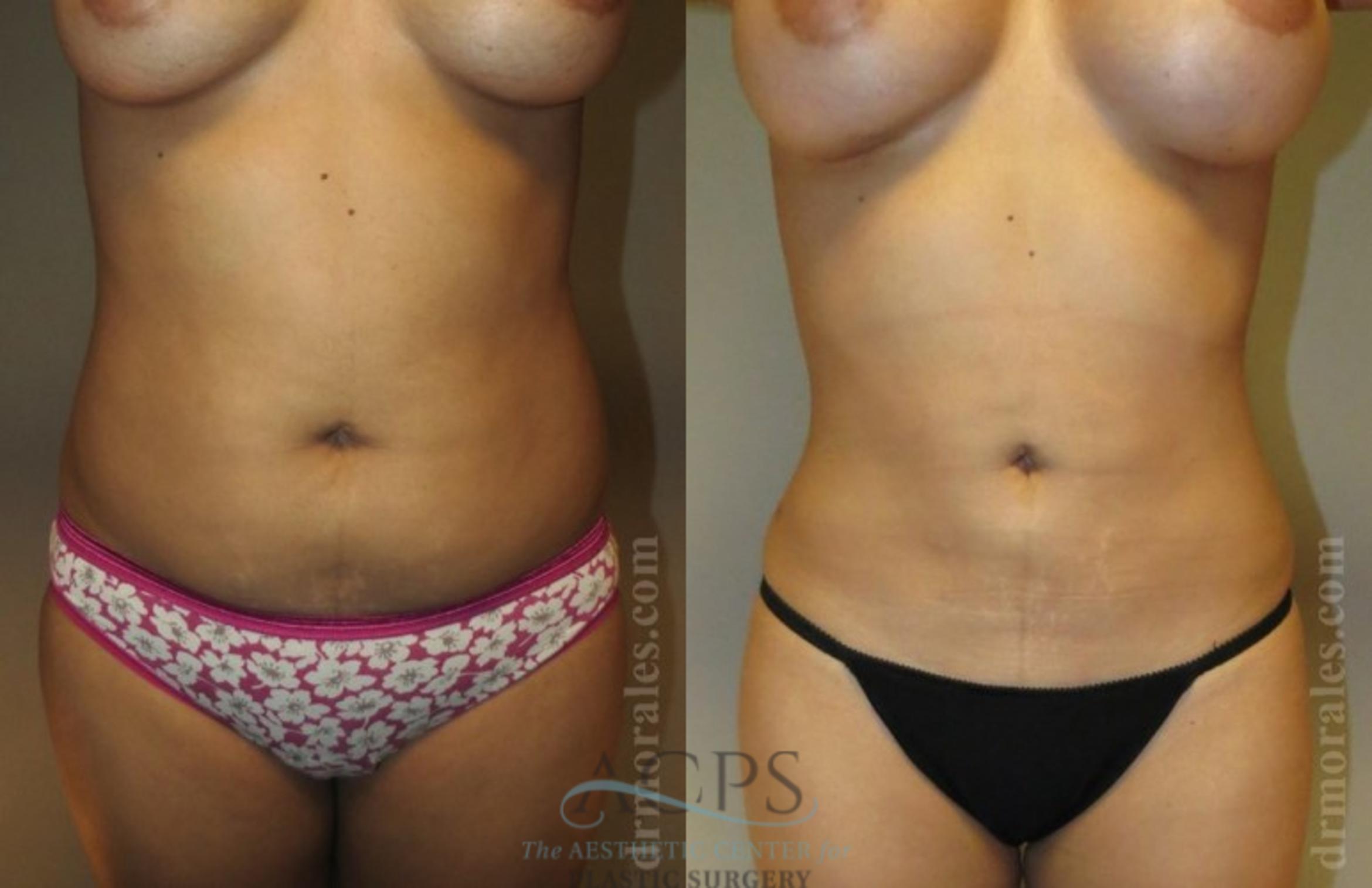 Before & After Liposuction Case 385 Front View: View in Houston, TX