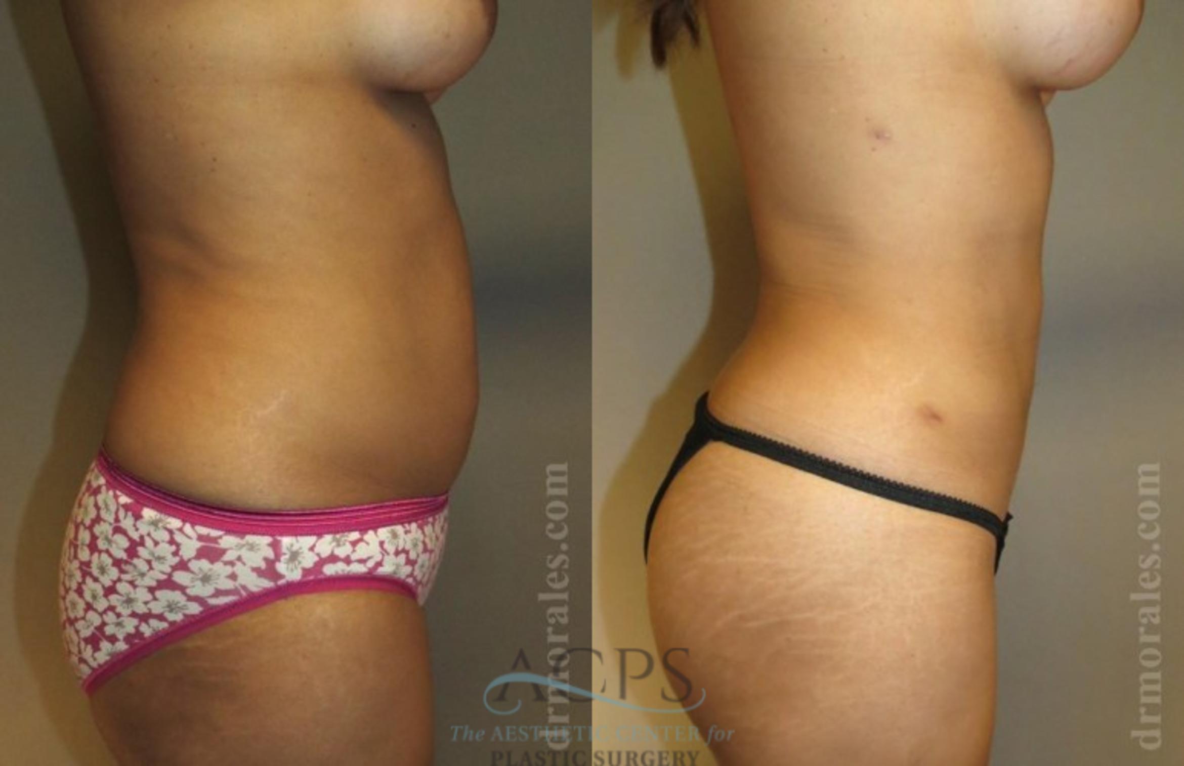 Before & After Liposuction Case 385 Side View: View in Houston, TX