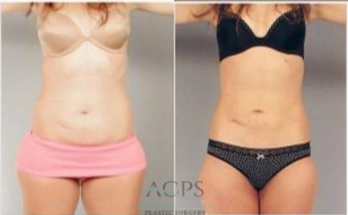 Before & After Liposuction Case 387 Front View: View in Houston, TX