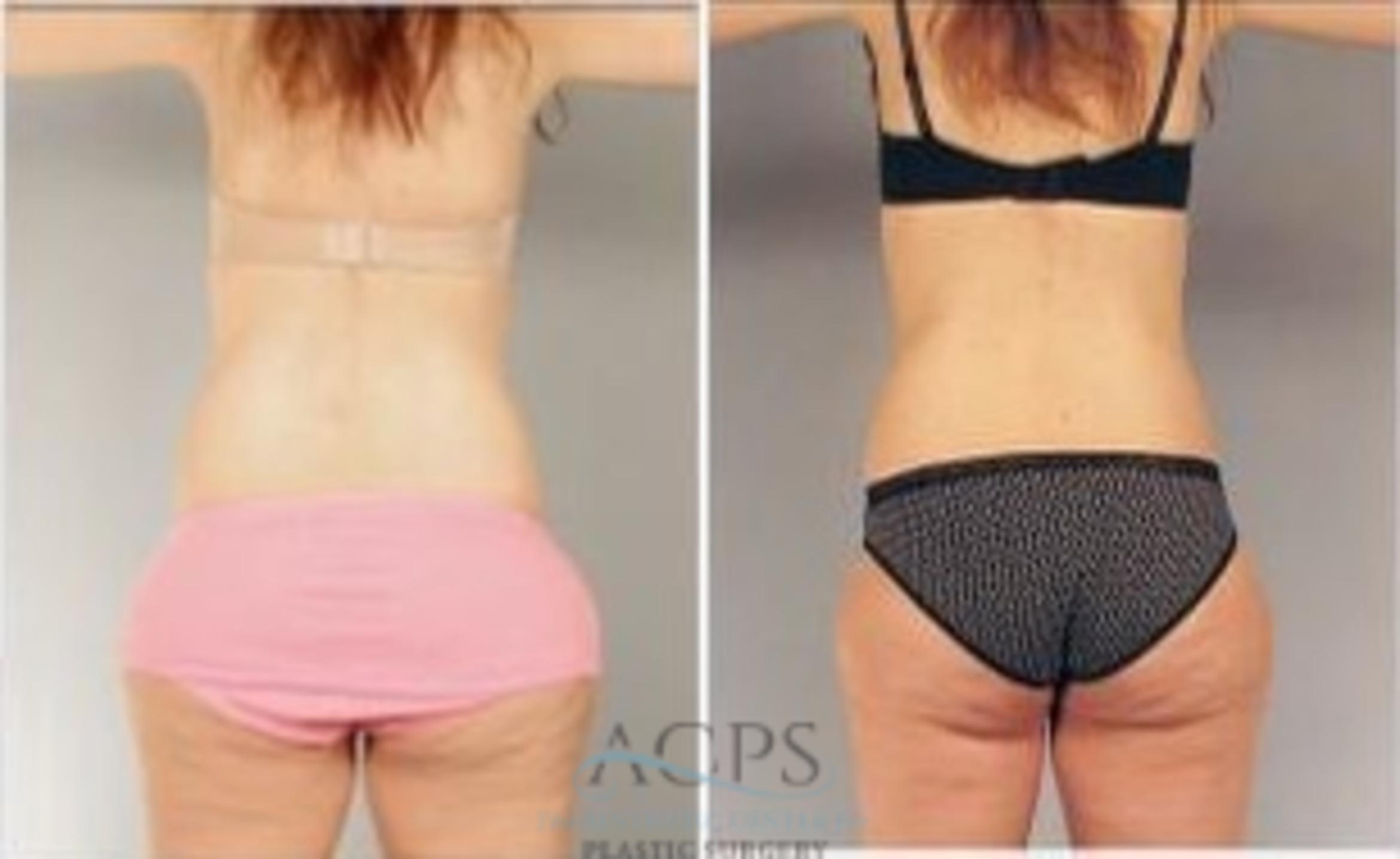 Before & After Liposuction Case 387 Rear View: View in Houston, TX
