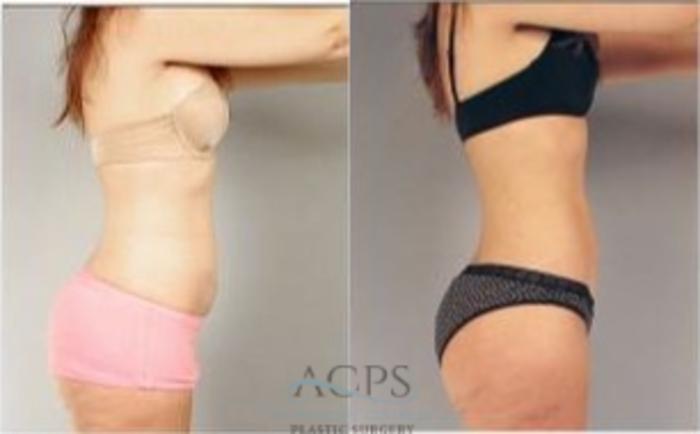 Before & After Liposuction Case 387 Side View: View in Houston, TX