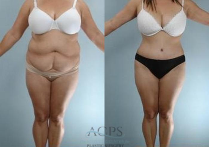 Before & After Liposuction Case 388 Front View: View in Houston, TX