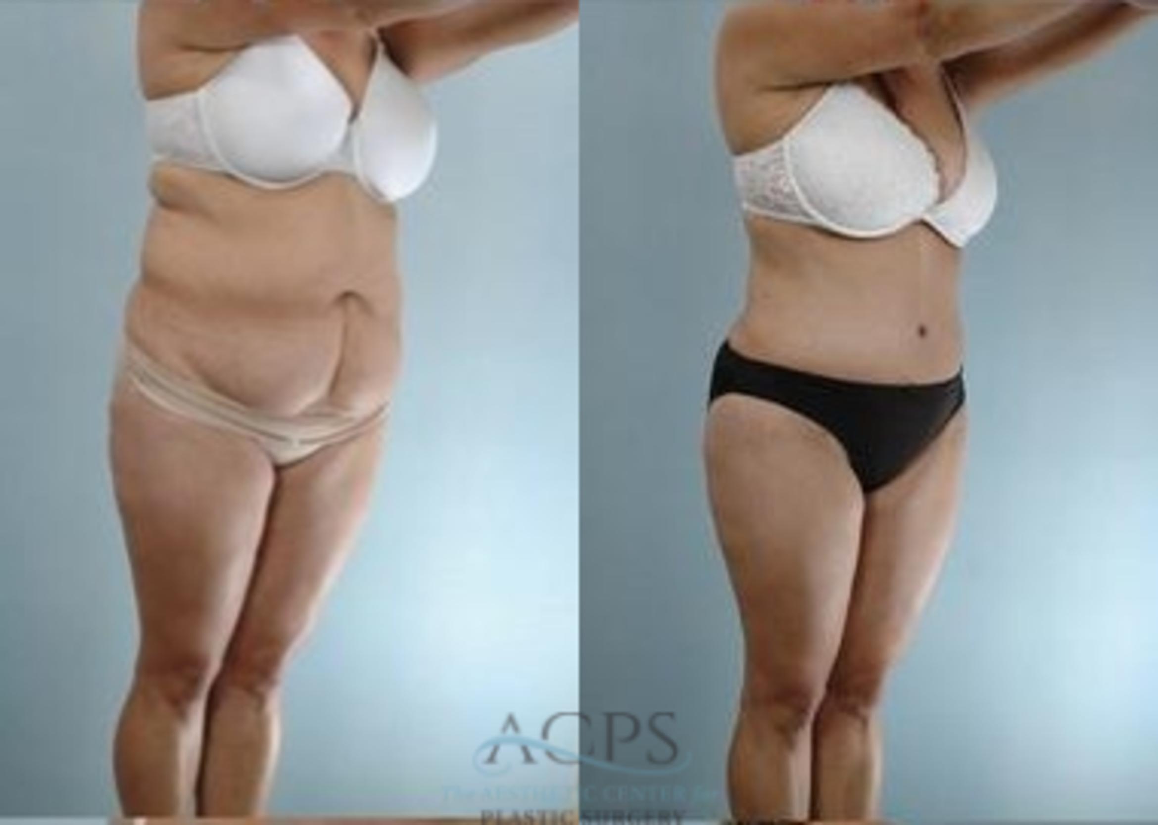 Before & After Liposuction Case 388 Oblique View: View in Houston, TX