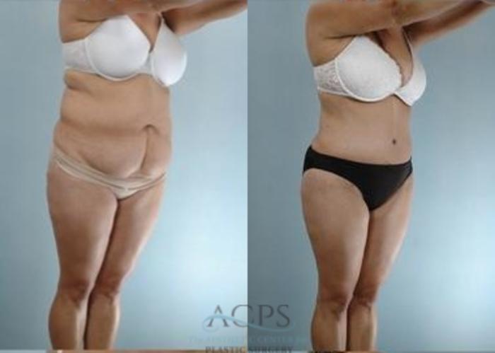 Before & After Liposuction Case 388 Oblique View: View in Houston, TX