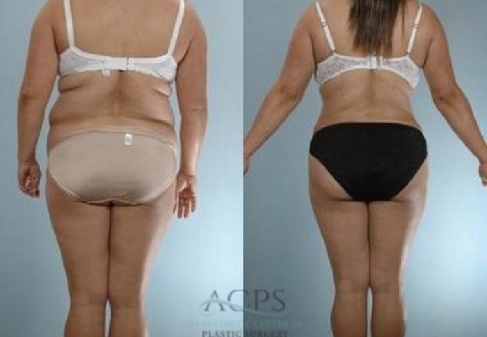 Before & After Liposuction Case 388 Rear View: View in Houston, TX