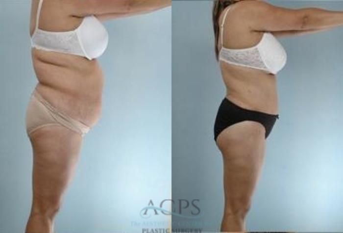 Before & After Liposuction Case 388 Side View: View in Houston, TX