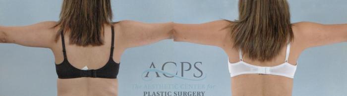 Before & After Liposuction Case 389 Rear View: View in Houston, TX
