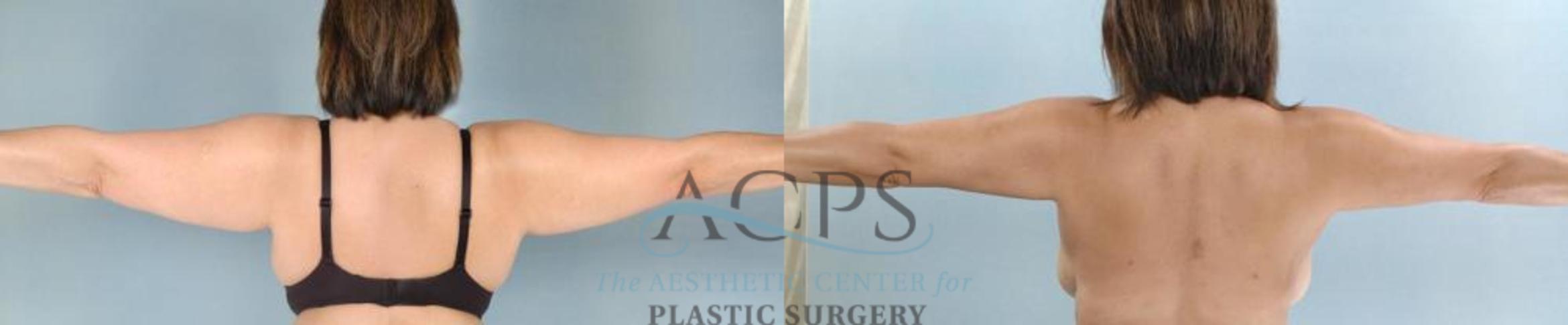 Before & After Liposuction Case 390 Rear View: View in Houston, TX