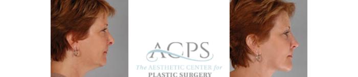 Before & After Liposuction Case 391 Side View: View in Houston, TX