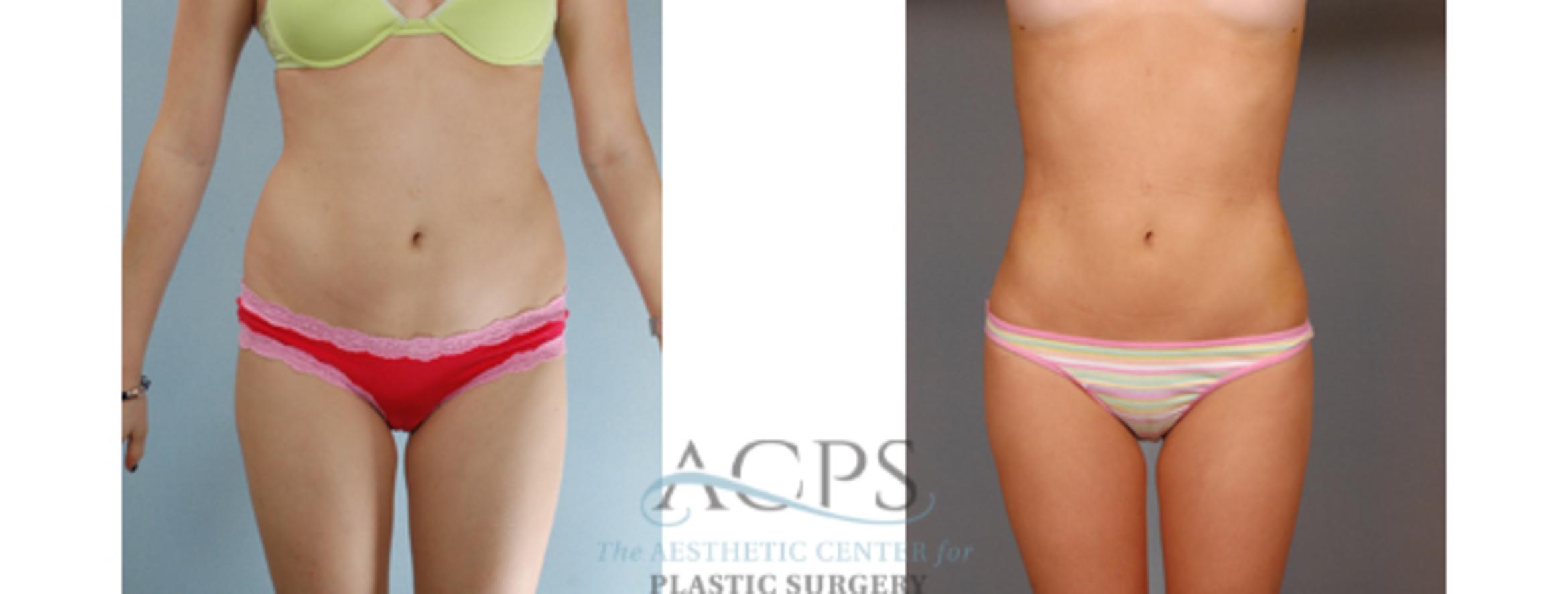 Before & After Liposuction Case 392 Front View: View in Houston, TX