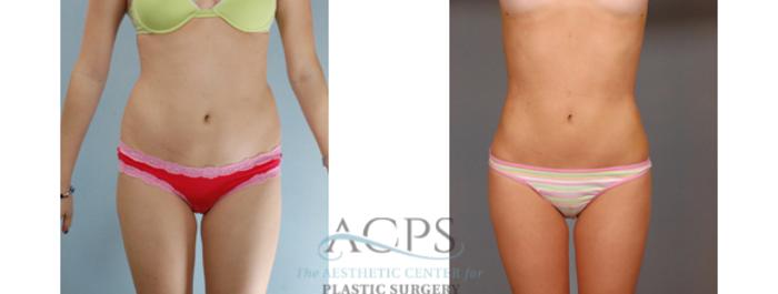 Before & After Liposuction Case 392 Front View: View in Houston, TX