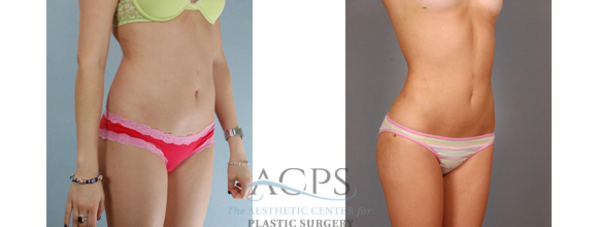 Before & After Liposuction Case 392 Oblique View: View in Houston, TX