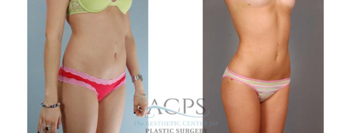 Before & After Liposuction Case 392 Oblique View: View in Houston, TX