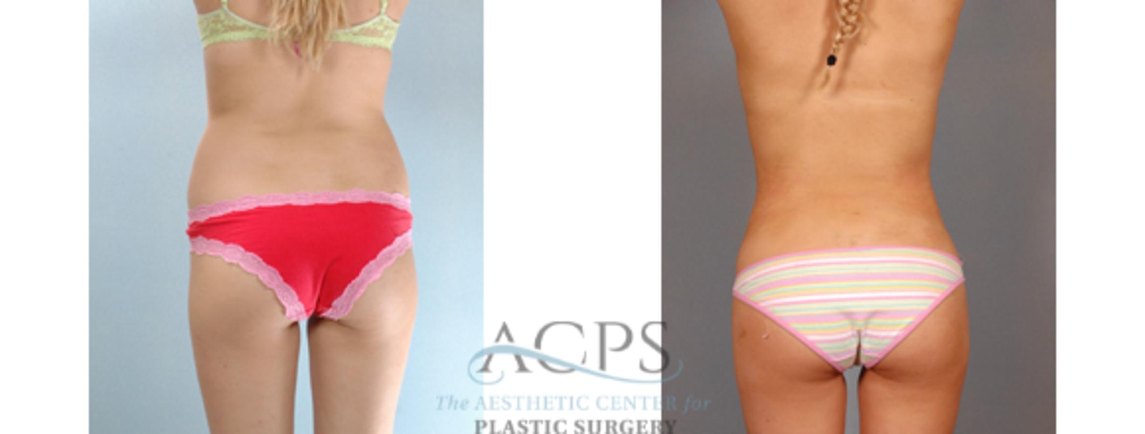 Before & After Liposuction Case 392 Rear View: View in Houston, TX