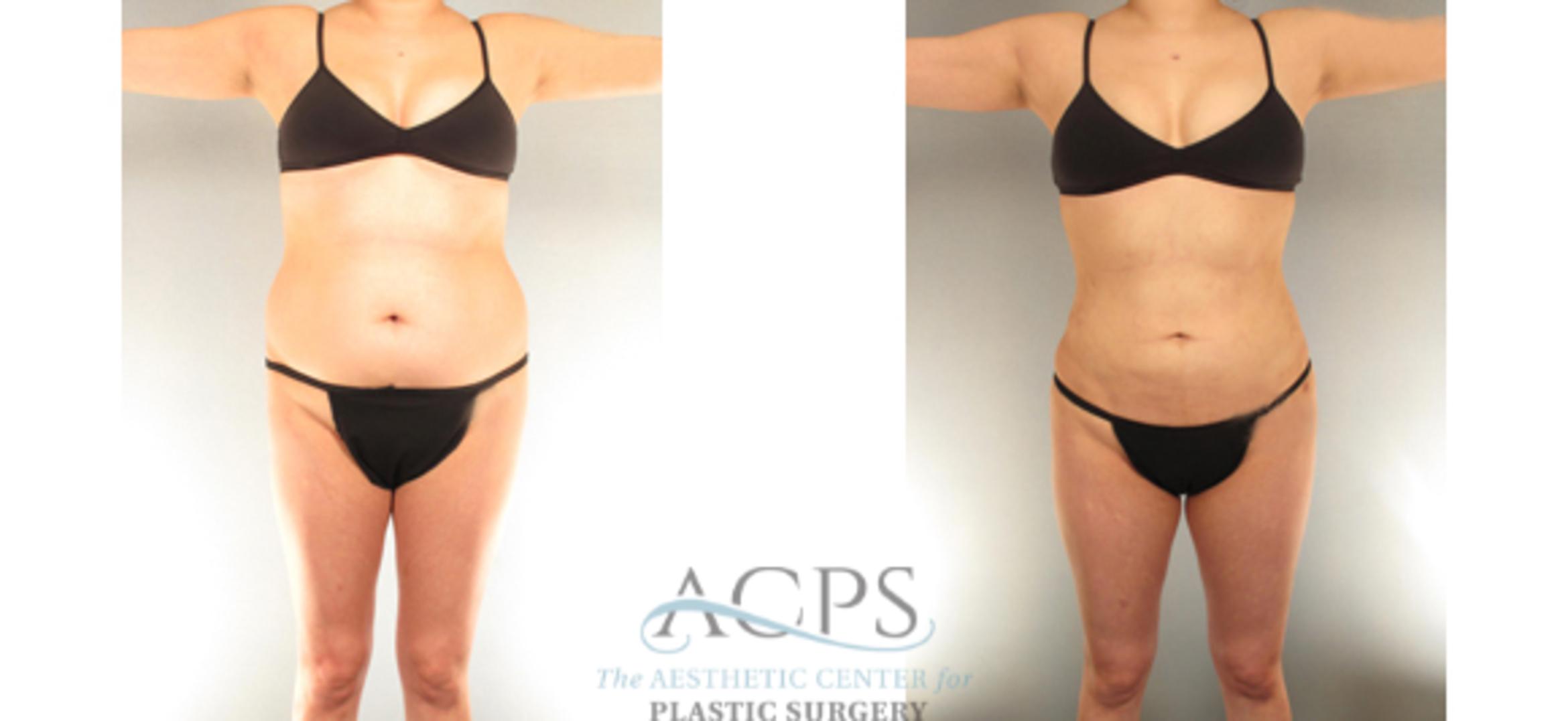 Before & After Liposuction Case 393 Front View: View in Houston, TX