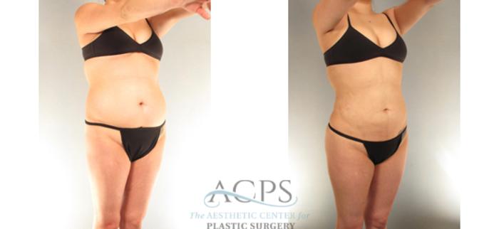 Before & After Liposuction Case 393 Oblique View: View in Houston, TX