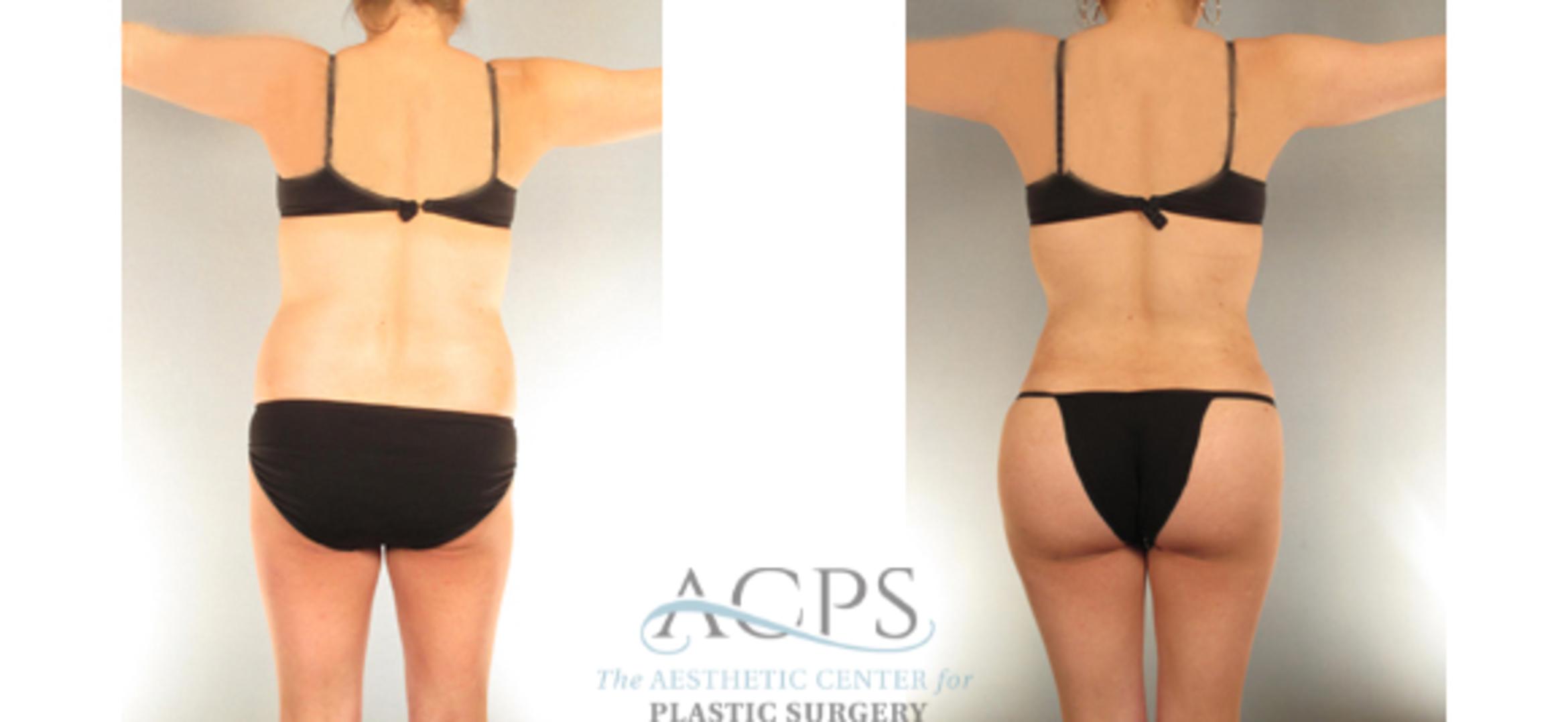 Before & After Liposuction Case 393 Rear View: View in Houston, TX