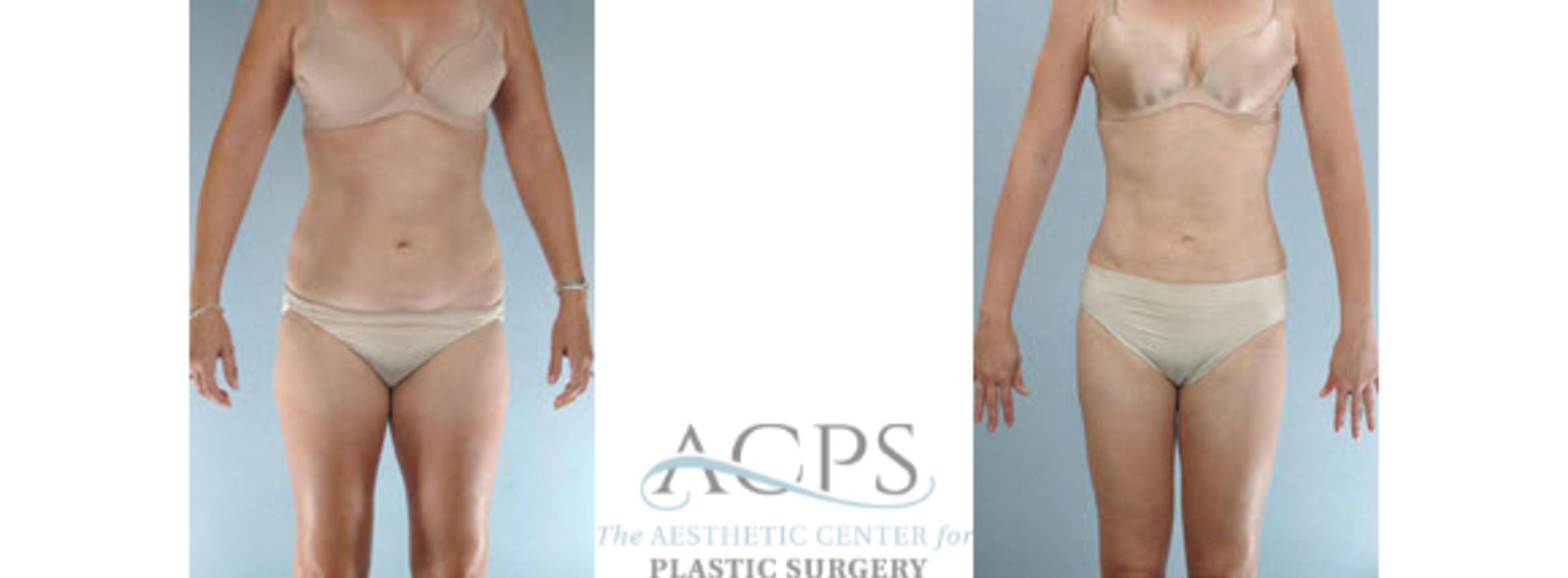 Before & After Liposuction Case 394 Front View: View in Houston, TX