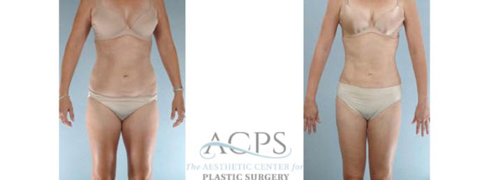 Before & After Liposuction Case 394 Front View: View in Houston, TX