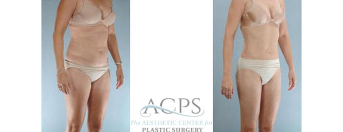 Before & After Liposuction Case 394 Oblique View: View in Houston, TX