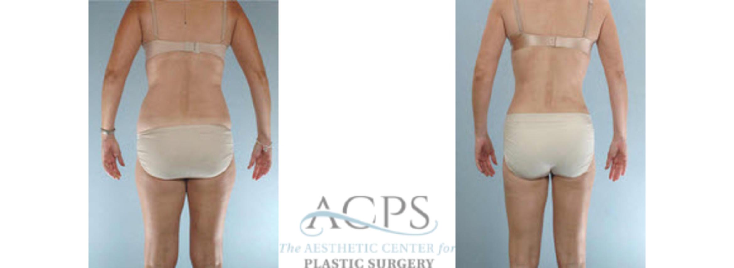 Before & After Liposuction Case 394 Rear View: View in Houston, TX