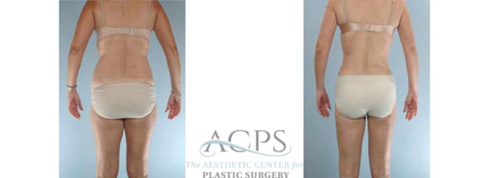 Before & After Liposuction Case 394 Rear View: View in Houston, TX